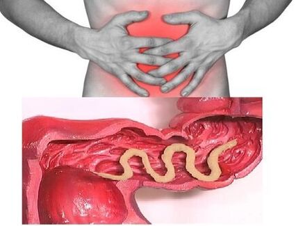 Les signes d'helminthiase chronique sont un trouble dyspeptique de l'intestin. 