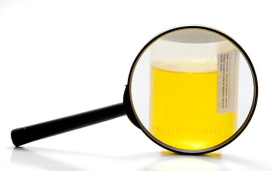 Test d'urine pour diagnostiquer la schistosomiase.